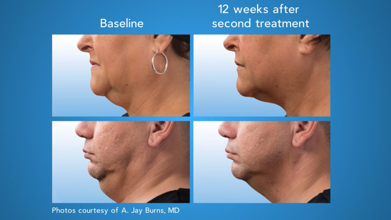 CoolSculpting Treatment FDACleared to Show Tightened Lax Tissue West