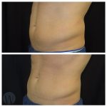 body treatments before and after