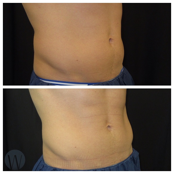 body treatments before and after