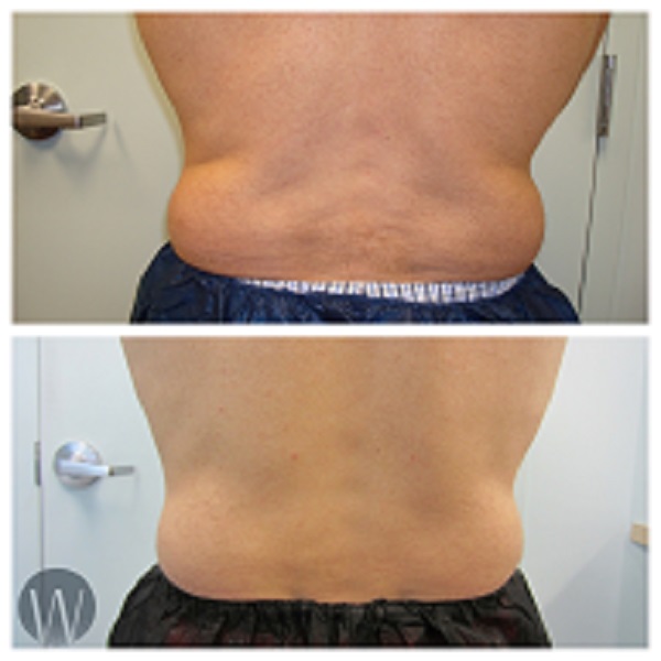 body treatments before and after