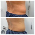 body treatments before and after