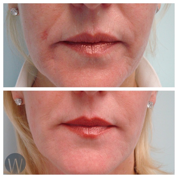dermal fillers before and after