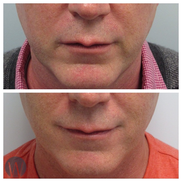 dermal fillers before and after