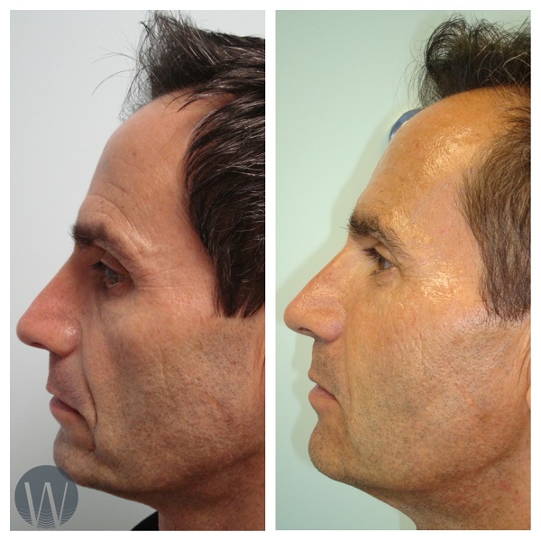 facial treatments before and after