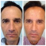 facial treatments before and after