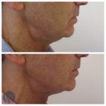 facial treatments before and after