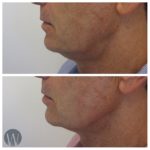 facial treatments before and after