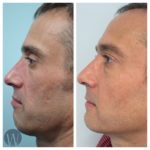 facial treatments before and after