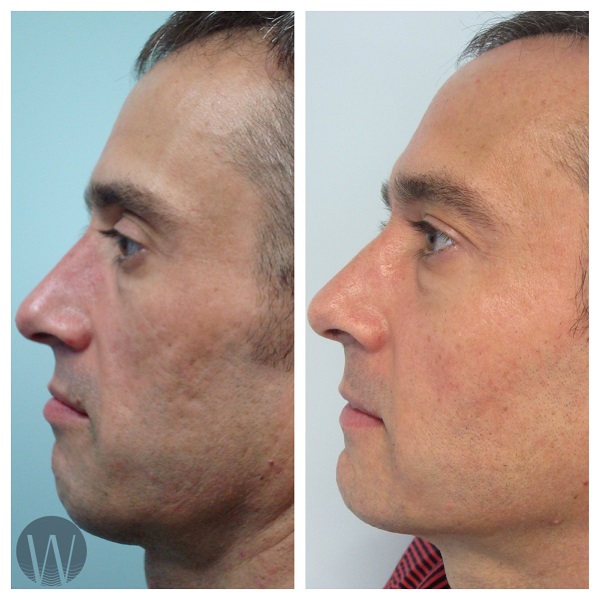 facial treatments before and after