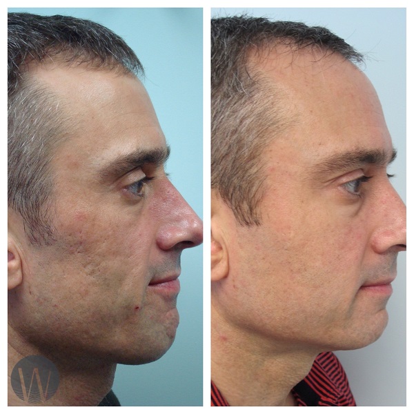 facial treatments before and after