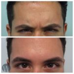 facial treatments before and after