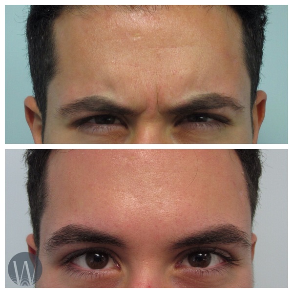 facial treatments before and after