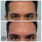 facial treatments before and after