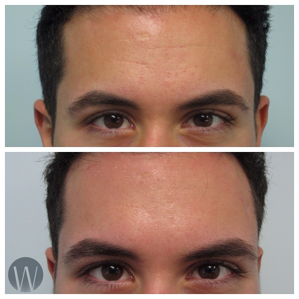facial treatments before and after