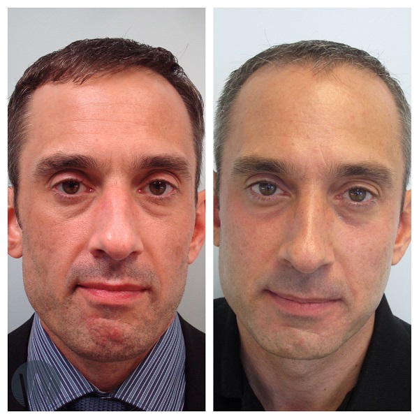 facial treatments before and after