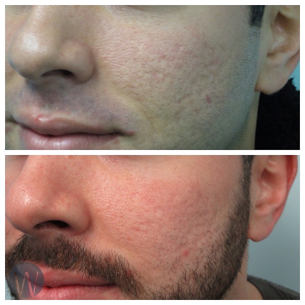 facial treatments before and after