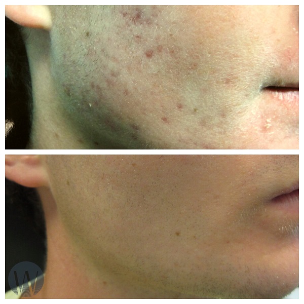 facial treatments before and after