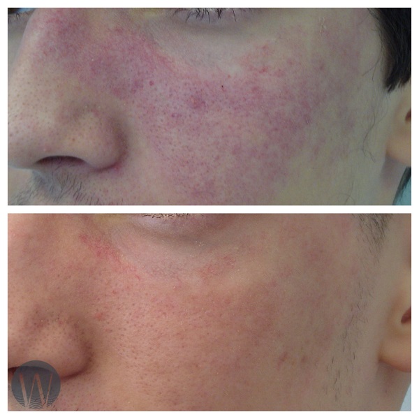 facial treatments before and after