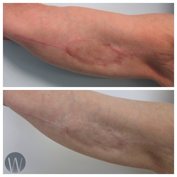 laser skin resurfacing before and after
