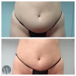 liposuction before and after