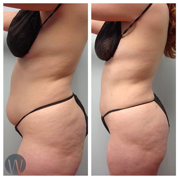 liposuction before and after