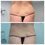 liposuction before and after