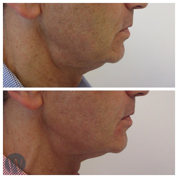 skin tightening before and after