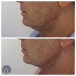 skin tightening before and after
