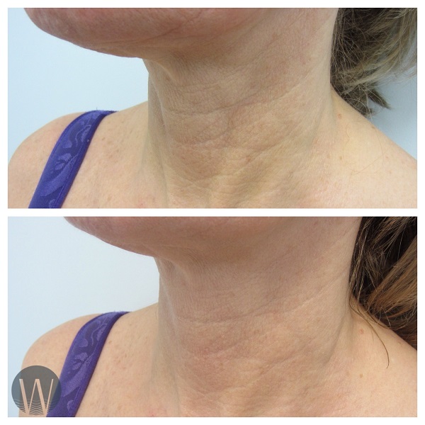 skin tightening before and after