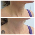 skin tightening before and after