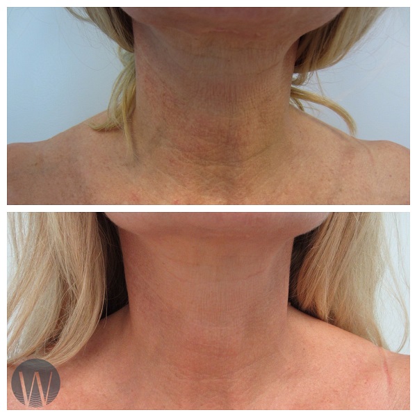 skin tightening before and after