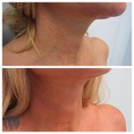 skin tightening before and after