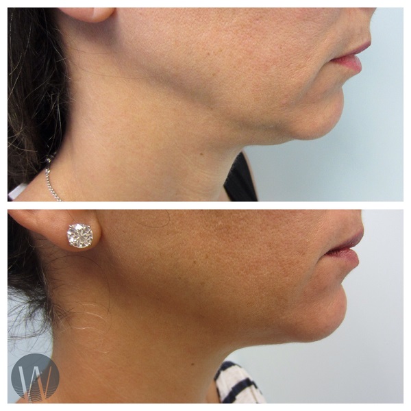 skin tightening before and after