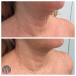 skin tightening before and after