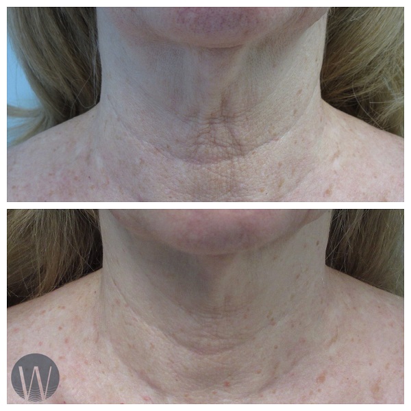 skin tightening before and after