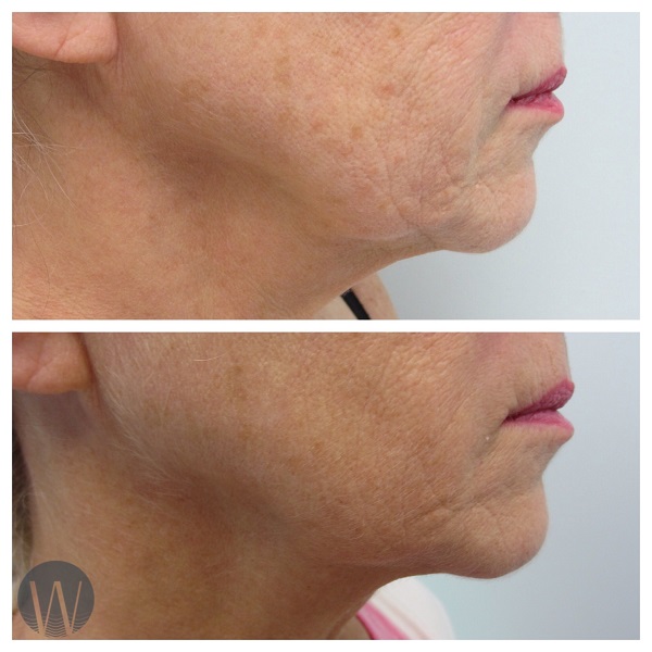 skin tightening before and after