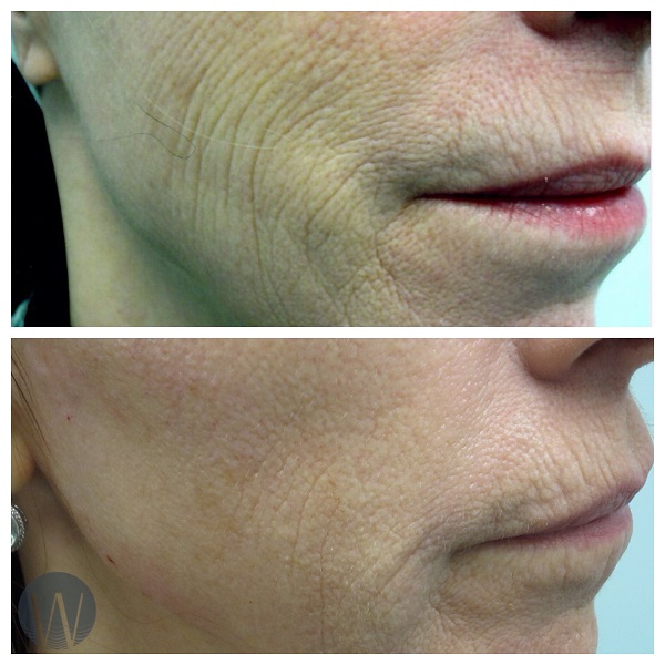 skin tightening before and after