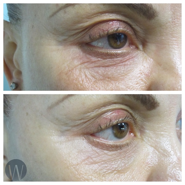 skin tightening before and after