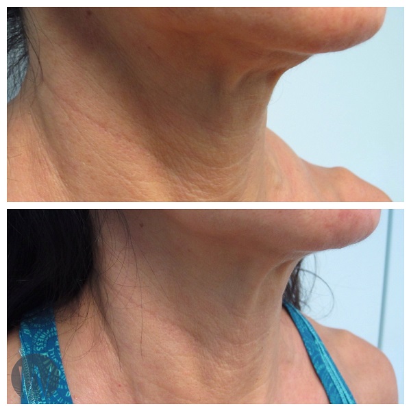 skin tightening before and after