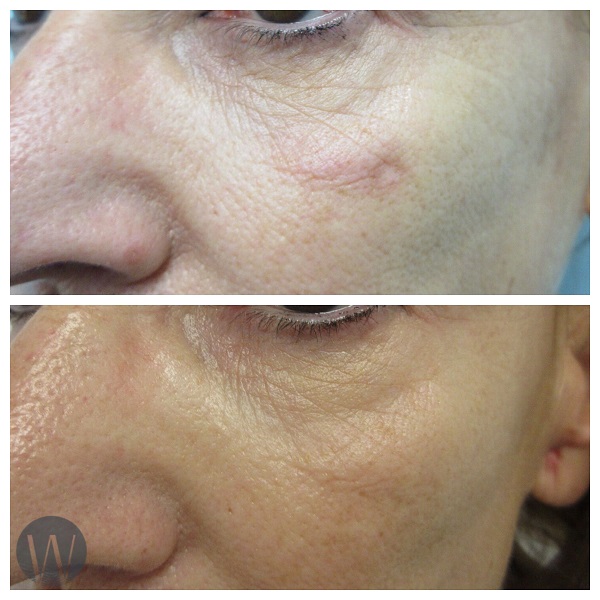 scar revision before and after