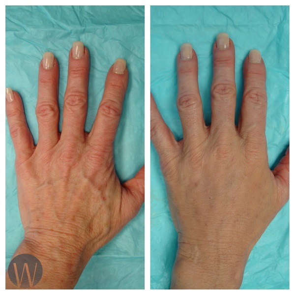 hand rejuvenation before and after