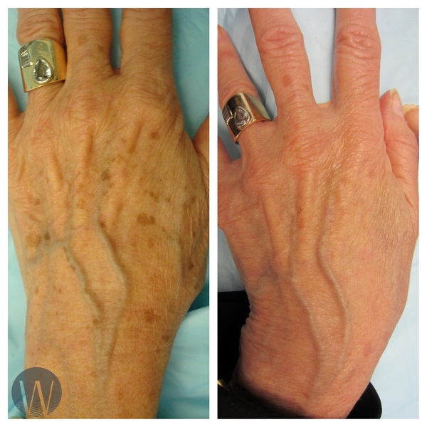 hand rejuvenation before and after