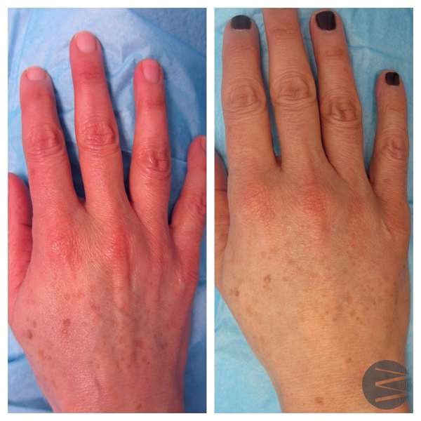 hand rejuvenation before and after