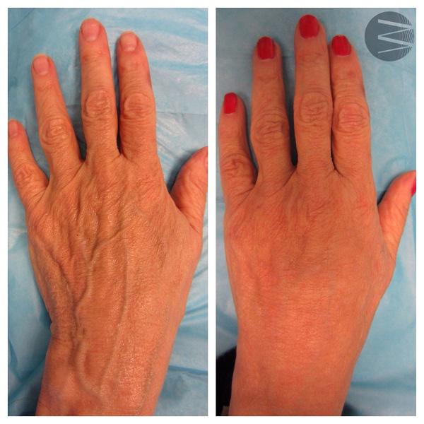 hand rejuvenation before and after