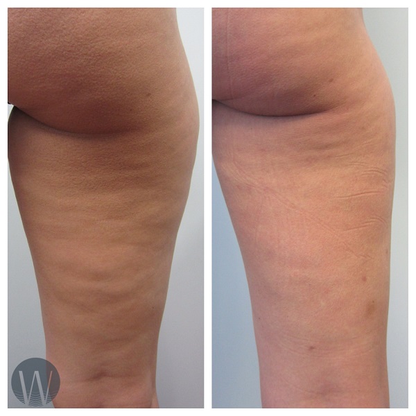 cellulaze before and after