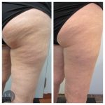 cellulaze before and after