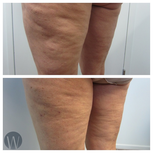 cellulaze before and after