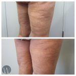 cellulaze before and after