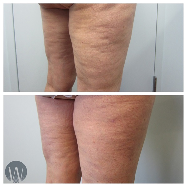 cellulaze before and after