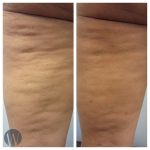 cellulaze before and after